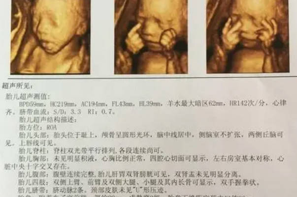 为什么胎儿头大腿短是男孩的情况比较多呢？
