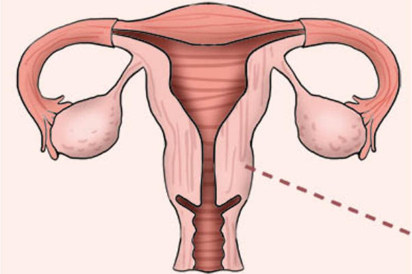 子宫畸形会导致月经紊乱