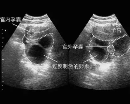 上海供卵代怀代生靠谱吗上海供卵三甲医院供卵怀孕可靠吗我现在已经完全恢复到了孕前的样子了
