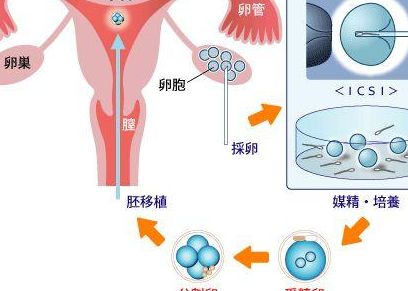 怀孕长息肉是胚胎生化了吗？试管全流程费用明细，过来人逐笔梳理