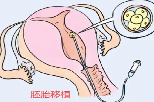 试管胚胎移植费用受胚胎类型影响