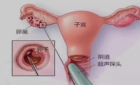 解读格鲁吉亚试管婴儿取卵前注意事项，要适当减少活动量