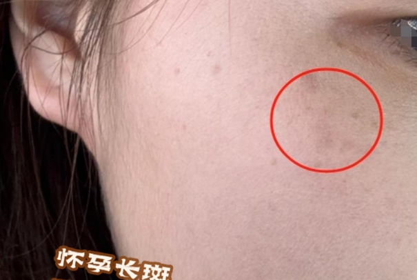 孕期长斑与胎儿的性别无关