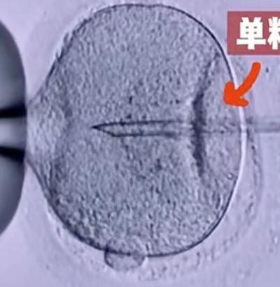 第二代试管和排名靠前代的区别：不只是精卵结合方式