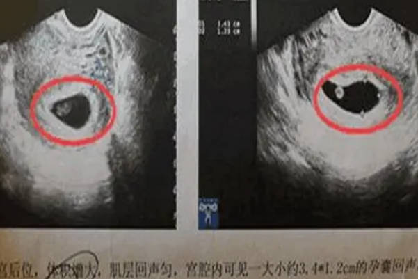 通过孕囊形状判断宝宝性别的说法不准确