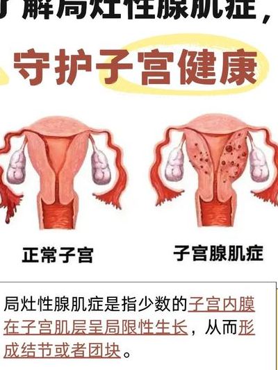 子宫腺肌症对怀孕的影响大吗?关键看病灶有没有伤到内膜这块地基