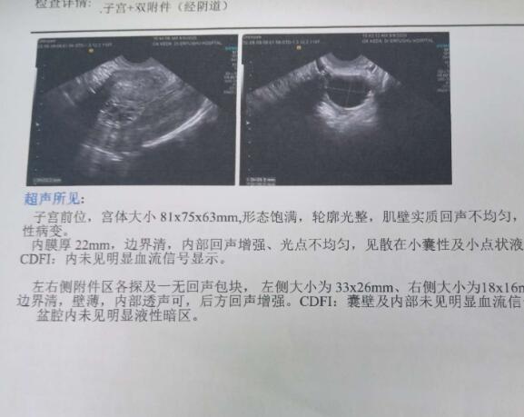 内膜薄不良妊娠几率高