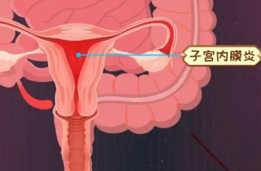 子宫内膜炎影响试管移植