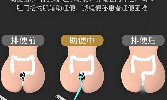 孕妇催便的方法5分钟，我试管怀上后靠它救命