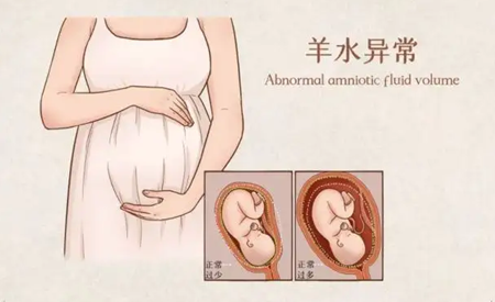 羊水指数多少mm正常