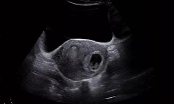 b超单孕囊常出现的位置