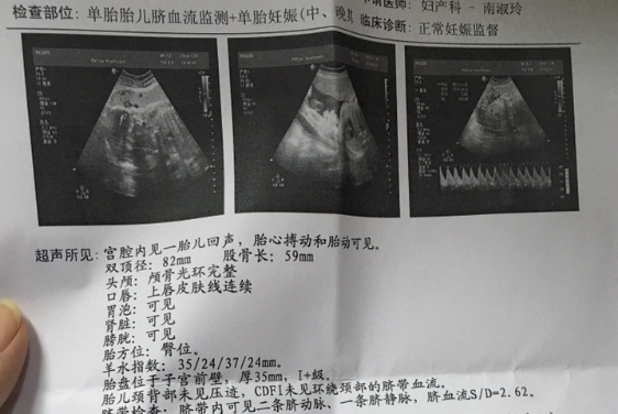 孕30周检查发现是臀位