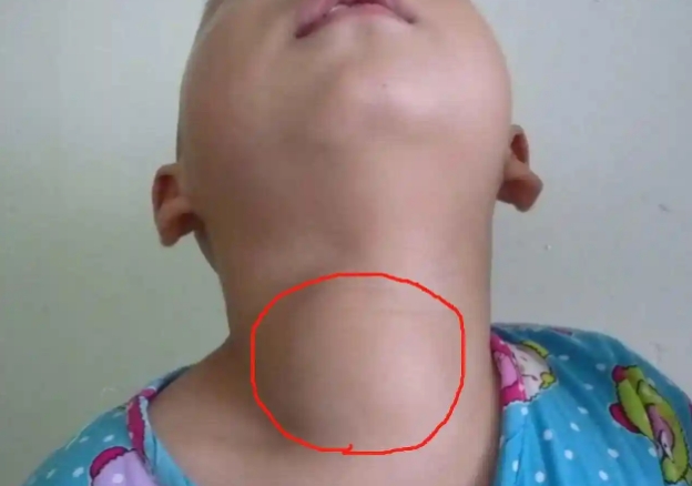 儿童甲状腺早期10个征兆