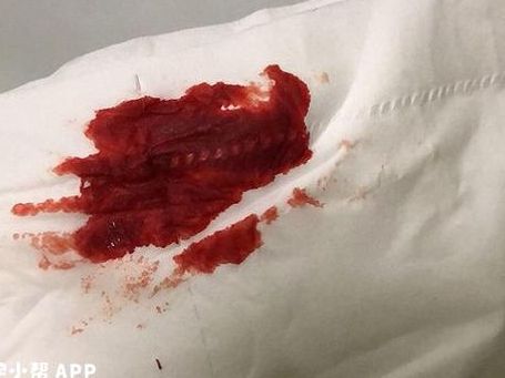 试管移植后第四天出血怎么回事？是着床还是失败了？