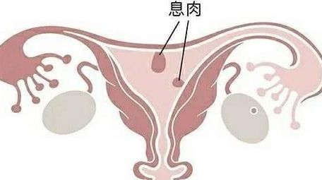 怀孕长的息肉会自然脱落吗 5个判断维度帮你定