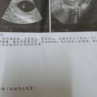 常州市妇幼保健院三代试管婴儿：两次胎停后，我查出了藏在染色体里的答案