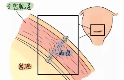 疤痕子宫缺陷可以做试管吗?厚度和胚胎数量有要求