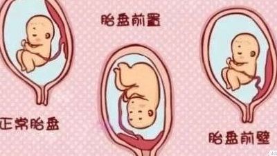 怀孕前壁累还是后壁累，试管后壁的我亲测后壁更磨人