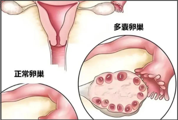 多囊卵巢做试管移植前一般要降LH