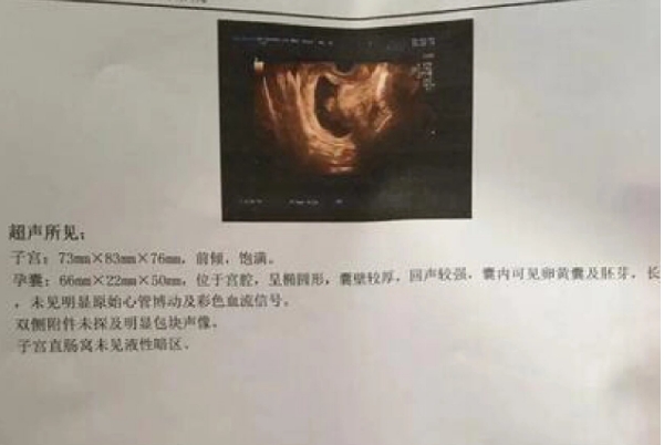 无胎心仍有保胎成功的几率