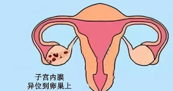 子宫内膜异位性不孕做试管能成功吗？