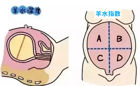 羊水深度和羊水指数的区别是什么