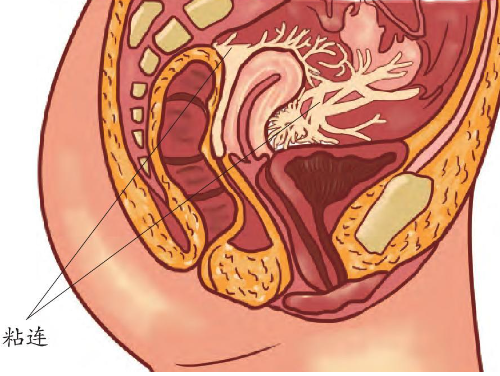 盆腔粘连会影响胚胎着床