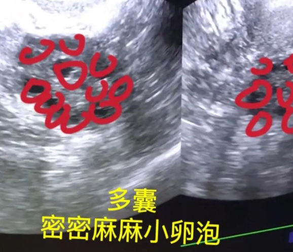 多囊卵巢多揉肚子
