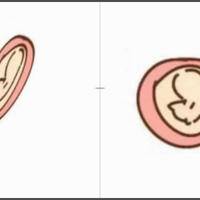 长孕囊和圆孕囊的区别，个体差异性的表现
