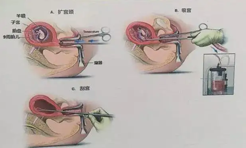 清宫手术过程 真实图片