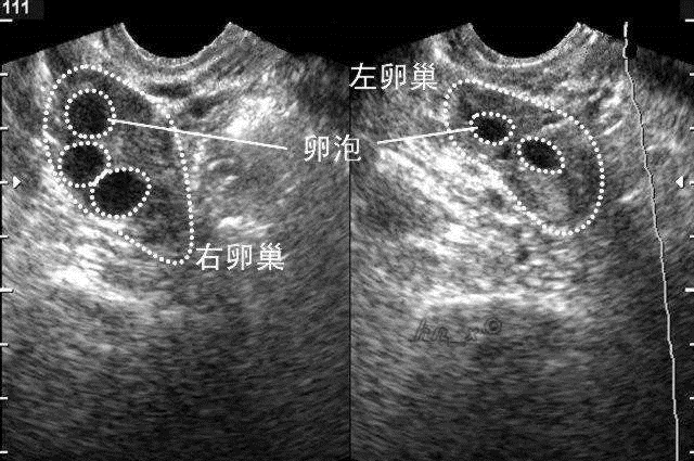 妇科彩超卵泡图片图片