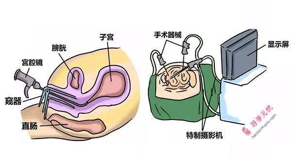宫腔镜检查全过程步骤(附图片)