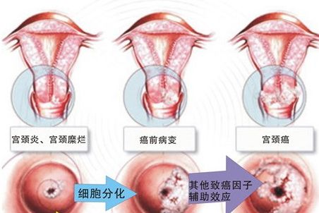 宫颈原位癌早期症状