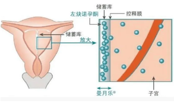 上曼月樂環需要住院嗎曼月樂環副作用是什麼