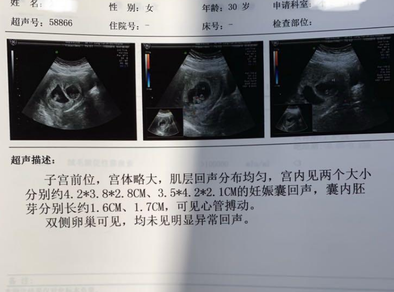 早孕双胎彩超报告图片图片