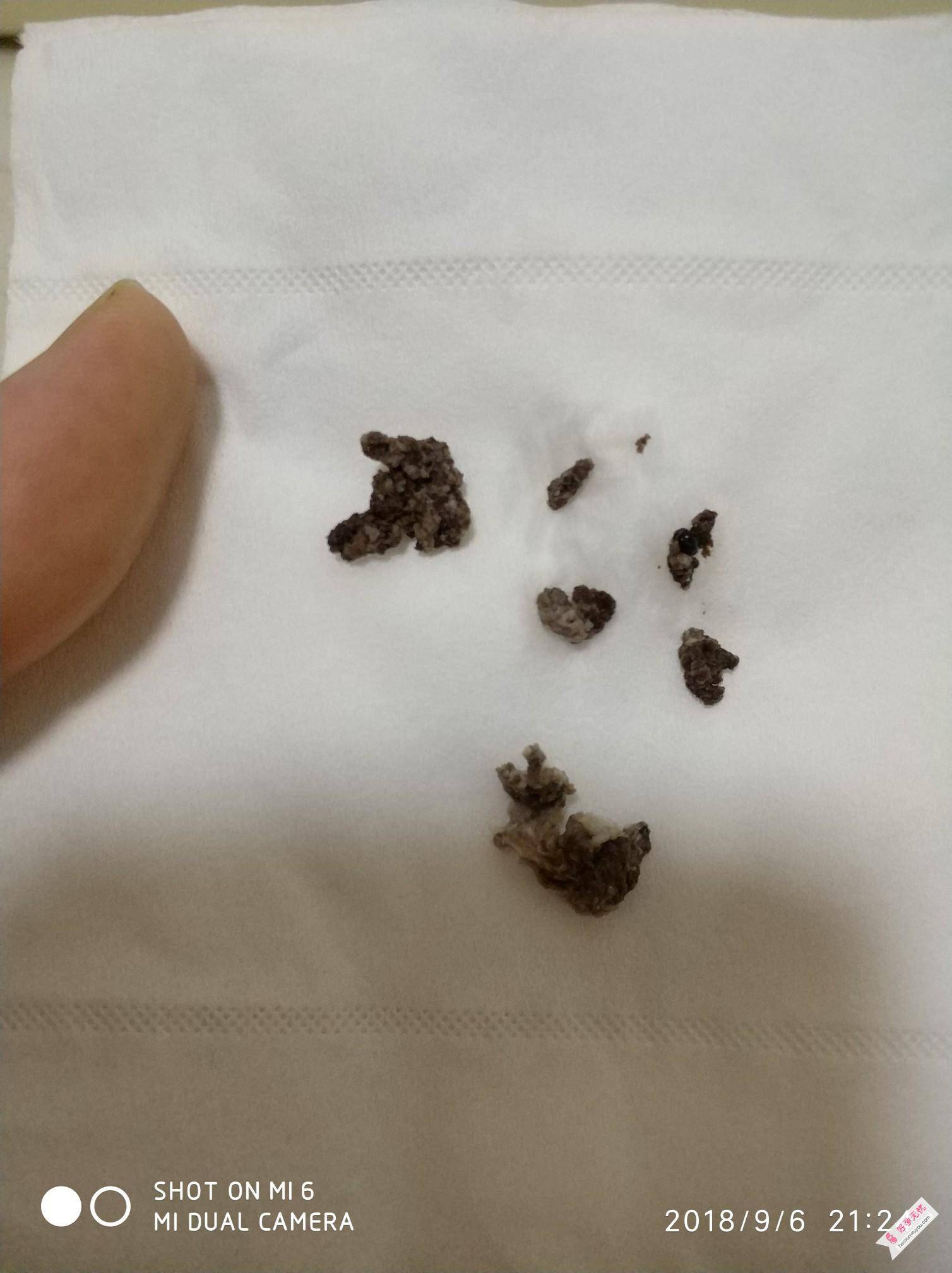 雪诺酮药渣突然成黑色还有点血块