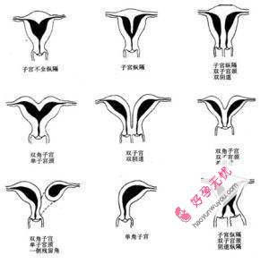 子宫畸形有哪些类型