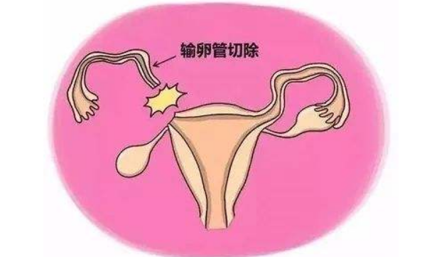 女性结扎好还是男性结扎好?是时候明确一下答案了